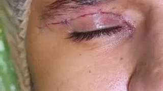 بلفاروپلاستی آقایان در کلینیک آرارز مشهد