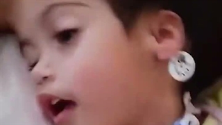دوقلوهای دو ساله پس از جداسازی از ناحیه سر جان باختند