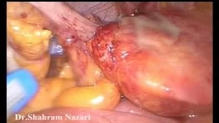 حالت التهابی در چربی ضمیمه ای روده، تشابه با آپاندیسیت