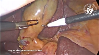 کوله‌سیستکتومی لاپاروسکوپیک در حضور شریان کبدی راست اکسسوری | دیسکسیون ایمن مثلث کالوت