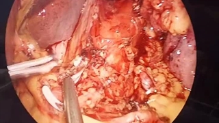 جراحی سرطان کاردیای معده لاپاراسکوپی