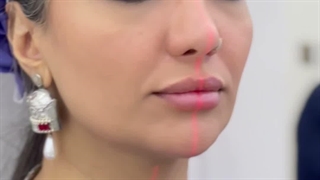 قرینه سازی به وسیله لیزر جهت کاشت مو و ابرو در کلینیک سینا همان رنسانس معروف